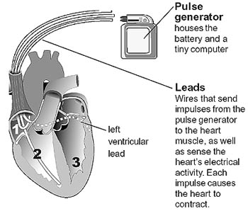 Biventricular Pacemaker