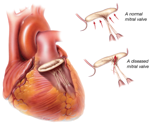 Degenerative valve disease