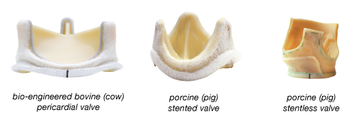 Tissue Valves (Bioprosthetic Valves)