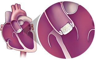 TAVR procedure